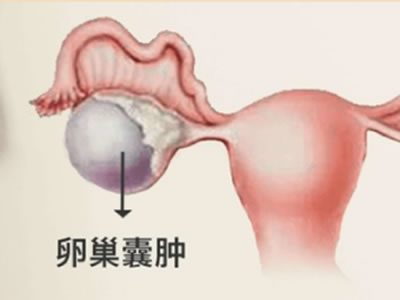 卵巢囊腫會癌變？！不用慌，注意事項在這里