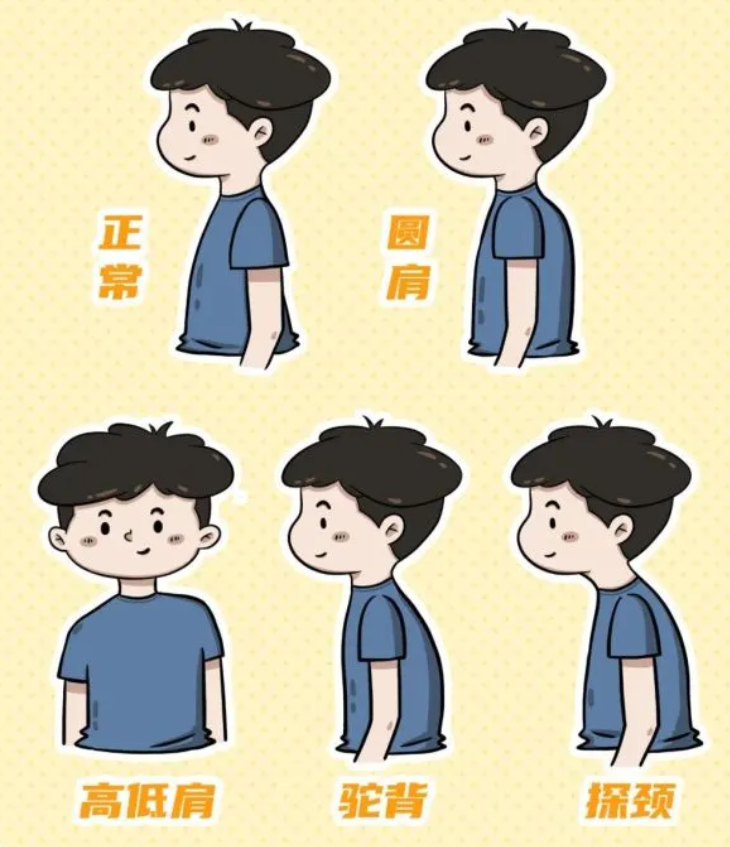 青少年脊柱側彎：別讓孩子的背，悄悄“彎”了！